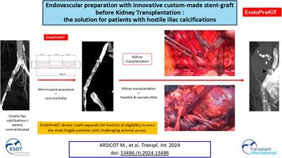 Endovascular Preparation With Innovative Custom-Made Stent-Graft Before Kidney Transplantation: The Solution for Patients With Hostile Iliac Calcification